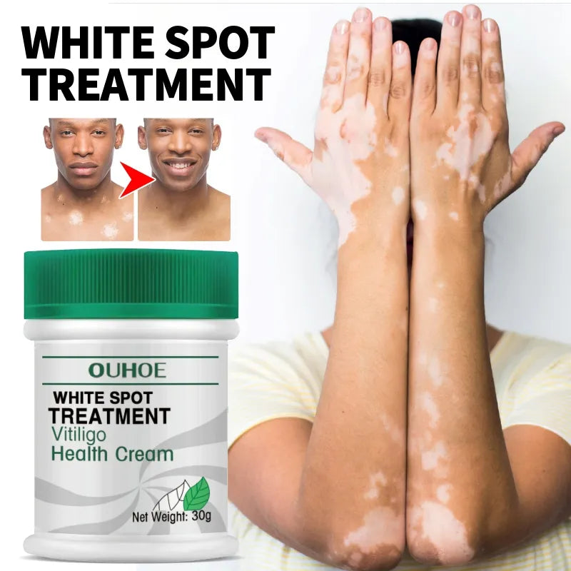 White Spot Skin Care Treatment Disease Cream