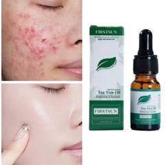 Tea Tree Pure Natural Essential Oils Acne Removal Essence Fade Acne Spots Serum Face Body Skin Whitening Fragrance Massage Oil