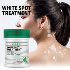 White Spot Skin Care Treatment Disease Cream